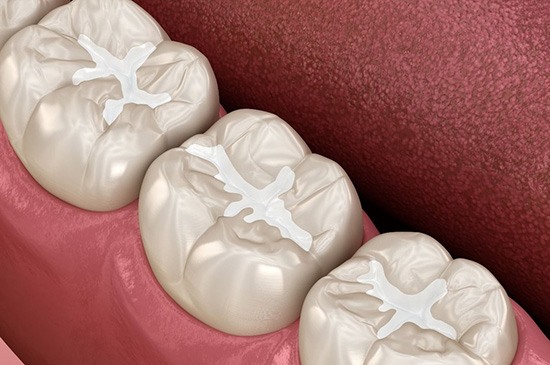 Composite Fillings - Ridgewood, NJ - Ridgewood Dental - Dental Filling